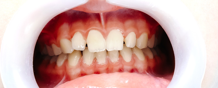 sbiancamento denti devitalizzati