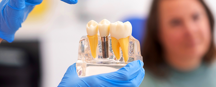 impianti dentali